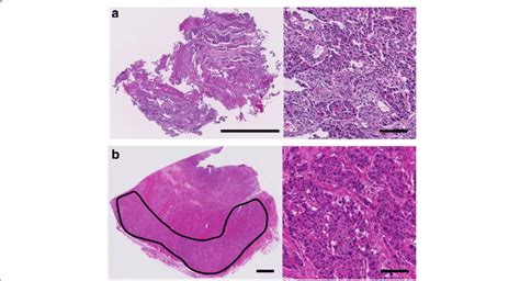 Photomicrographs of a case harboring a PIK3CA mutation in both types of ...