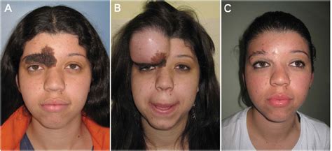 RBCP - Therapeutic options in the management of giant congenital nevus ...