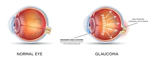 Glaucoma Treatment - South Georgia / North Florida Eye Partners