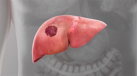 Liver cancer: Symptoms, Causes, and Treatment - Scientific Animations