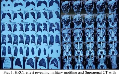 Figure 1 from A Camouflaged Case of Disseminated Tuberculosis Presenting as Adrenal Crisis ...