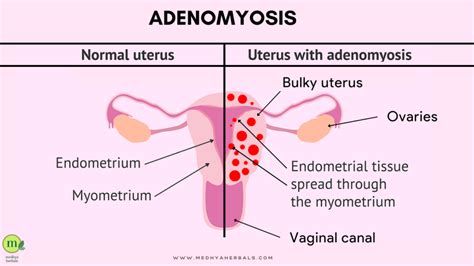 Ayurveda for Endometriosis | Health Tips for Endometriosis