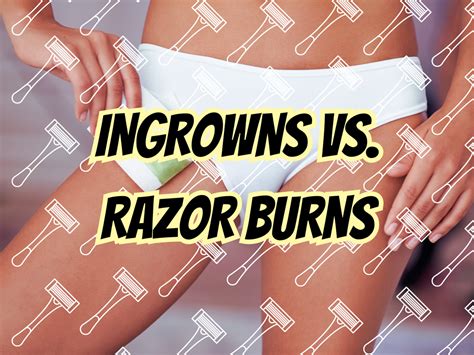 Understanding Ingrown Hair vs. Razor Burns: Differences, Causes, and Remedies – Hibiscus Monkey