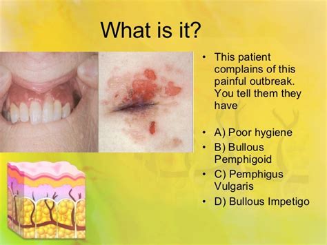 Pemphigus vulgaris