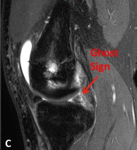 Ghost Sign Meniscal Root Tear MRI - Robert LaPrade MD | Orthopedic Knee Specialist Sports ...