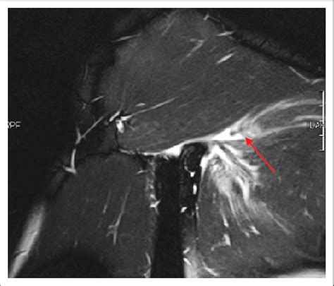 Pectoralis Major Tendon Tear