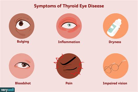 Thyroid Eye Disease: Symptoms, Causes, Diagnosis, and Treatment