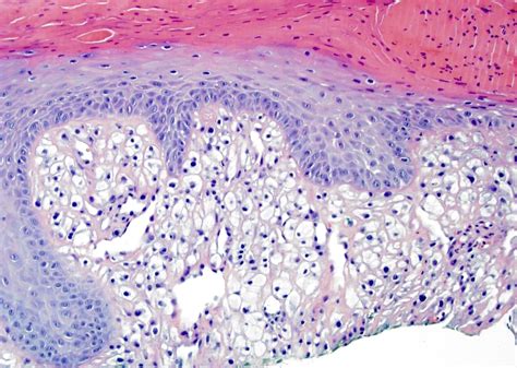 Fibrous Papule Histology