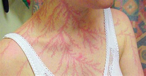 Lichtenberg Scars — Nature’s Tattoo You Don’t Want To Have | Lightning ...
