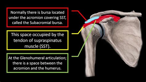 Subdeltoid Bursitis