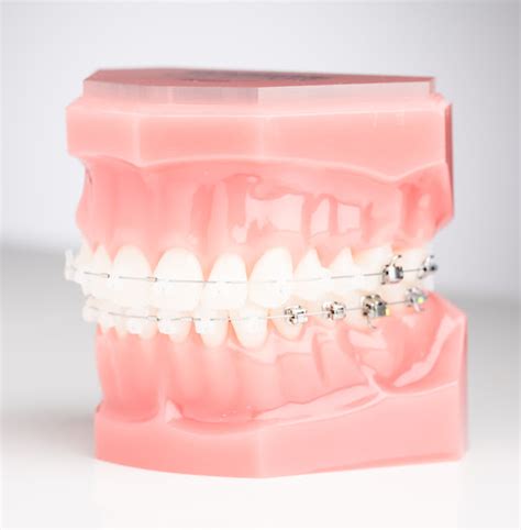 My Braces Doctor | Self-Ligating Ceramic Braces in Alexandria