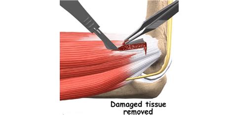 Medial Epicondylitis Symptoms, Causes and Treatment