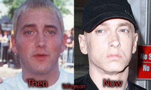 Eminem Plastic Surgery, Before and After Facelift Pictures