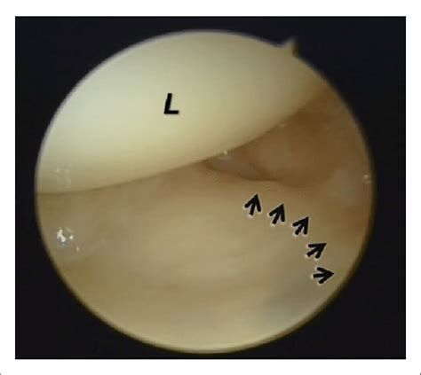 Radiocarpal arthroscopy (right wrist – scope in 3-4 portal) shows a... | Download Scientific Diagram