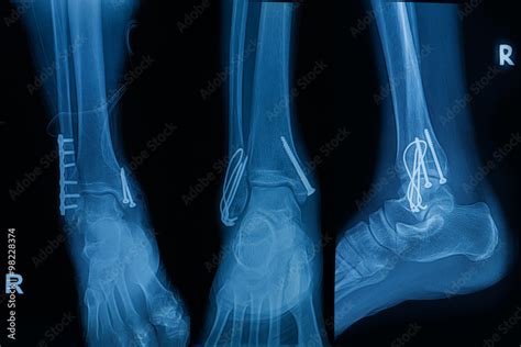 Collection of human x-rays showing fracture of right leg ( fracture both bones ) Stock ...