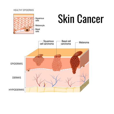 Basal Cell Skin Cancer Stages