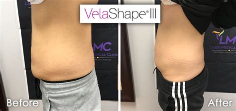 Velashape Before And After Abdomen