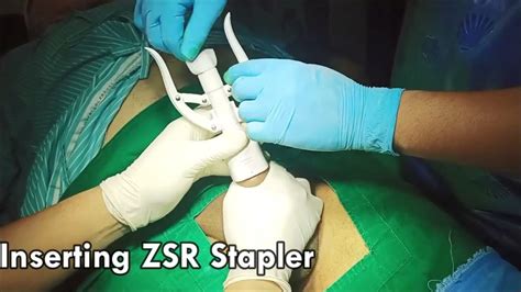 ZSR Stapler Circumcision Surgery | Circumcision Treatment in Vesu ...