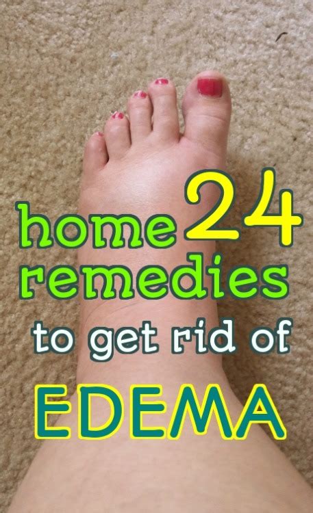 Home Remedy Hacks • 24 Effective Home Remedies To Treat Edema