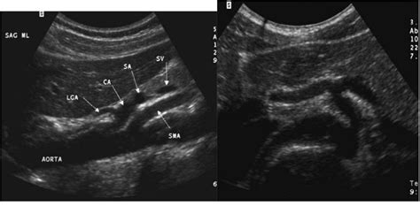 Mesenteric Artery Ultrasound Pictures | Diagnostic medical sonography, Sonography, Ultrasound ...