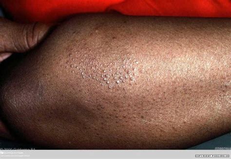 Lichen spinulosus | Primary Care Dermatology Society | UK