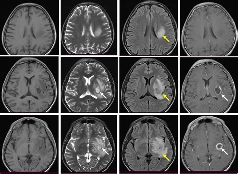 Cerebral abscess – Radiology Cases