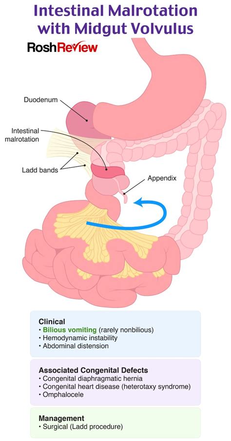 Intestinal Malrotation with Midgut Volvulus | Pediatric medicine ...