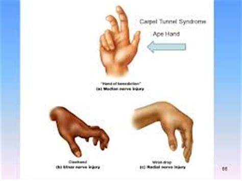 ape hand deformity, wrist drop, claw | Hand therapy, Medical school essentials, Home exercise ...