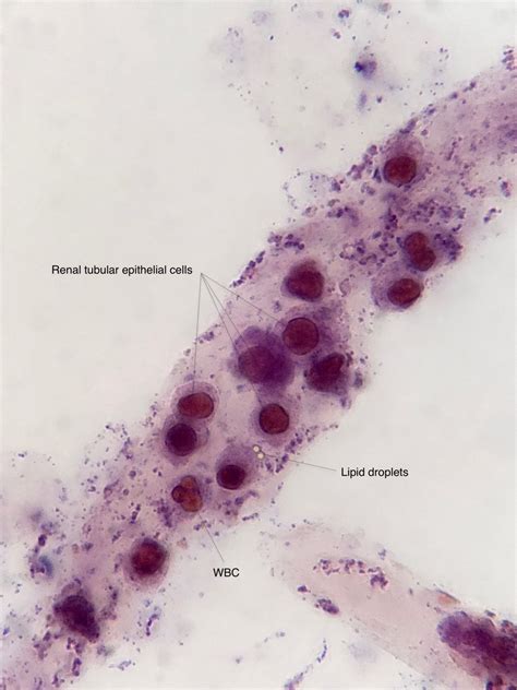 Urine Sediment of the Month: Renal Tubular Epithelial Cells - Renal ...