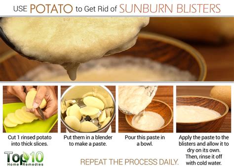 How to Get Rid of Sunburn Blisters | Top 10 Home Remedies