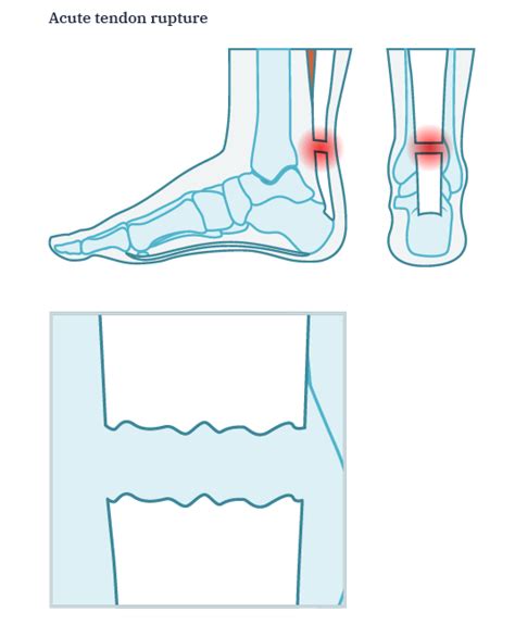 Achilles tendon rupture symptoms and treatment options