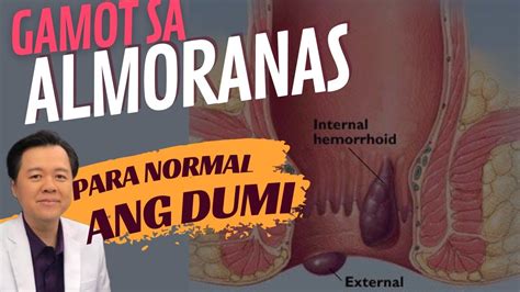 Gamot sa Almoranas at Para Maging Normal ang Pagdumi - Tips ni Doc Willie Ong - YouTube