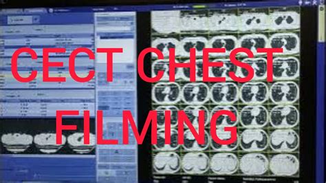 CT SCAN CHEST CONTRAST FILMING. - YouTube