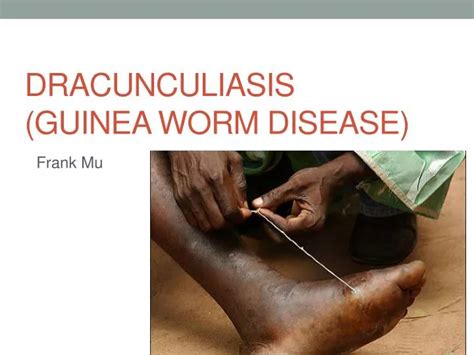 PPT - Dracunculiasis (Guinea Worm Disease) PowerPoint Presentation ...