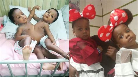 Conjoined twins successfully separated by 78-member team in Nigeria | 7NEWS.com.au