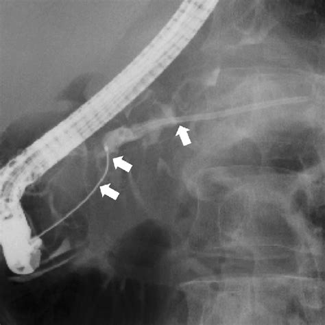 ERCP view showing proximally migrated stent fragment and multiple ...