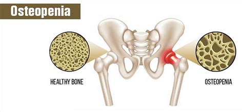 Osteopenia definition, causes, prevention, diet, symptoms, diagnosis & treatment