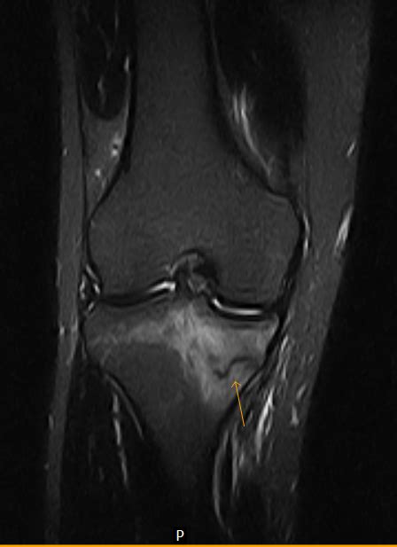 Medial Tibial Condyle Stress Fracture-MRI - Sumer's Radiology Blog