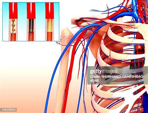 Carotid Artery Stent Photos and Premium High Res Pictures - Getty Images