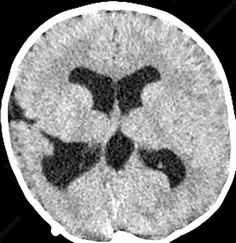 Schizencephaly, CT scan - Stock Image - C030/6479 - Science Photo Library