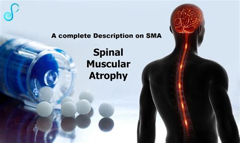 What Actually Spinal Muscular Atrophy Is (SMA) ~ SMA Families