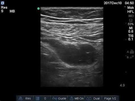 Case 4 : Perforated Appendicitis - YouTube