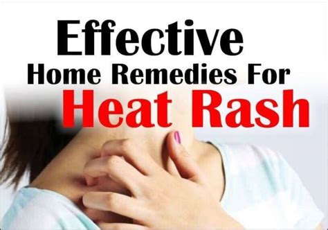 Heat Rash: Treatment, Causes & How To Prevent? - Health Blog