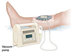 Negative Pressure Wound Therapy | Saint Luke's Health System