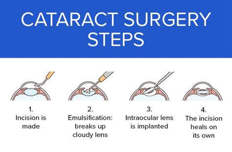 Cataract Surgery: Procedure, Description, Options