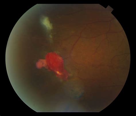 Moran CORE | Sickle Cell Retinopathy