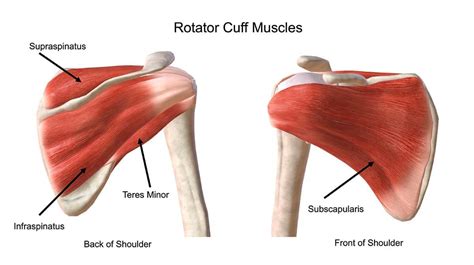 Supraspinatus Muscle Tear