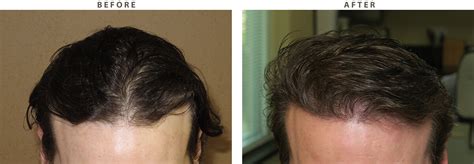 FUE Hair Transplantation – Before and After Pictures * | Dr Turowski - Plastic Surgery Chicago