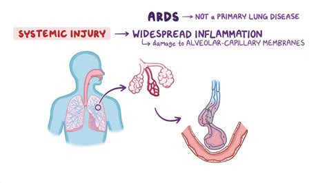 Acute respiratory distress syndrome (ARDS): Nursing - Osmosis Video Library