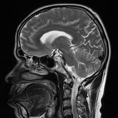 Ultimate Radiology : Dolichoectasia of the Vertebrobasilar System